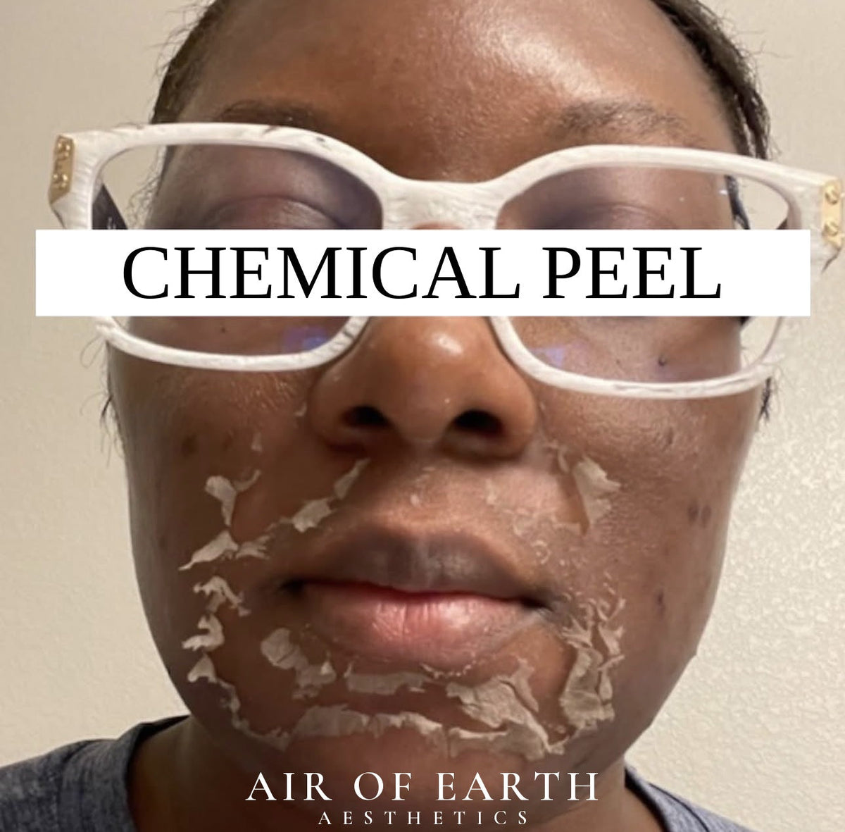 Can Black Skin Get Chemical Peels? What’s Actually Safe—and What Isn’t?