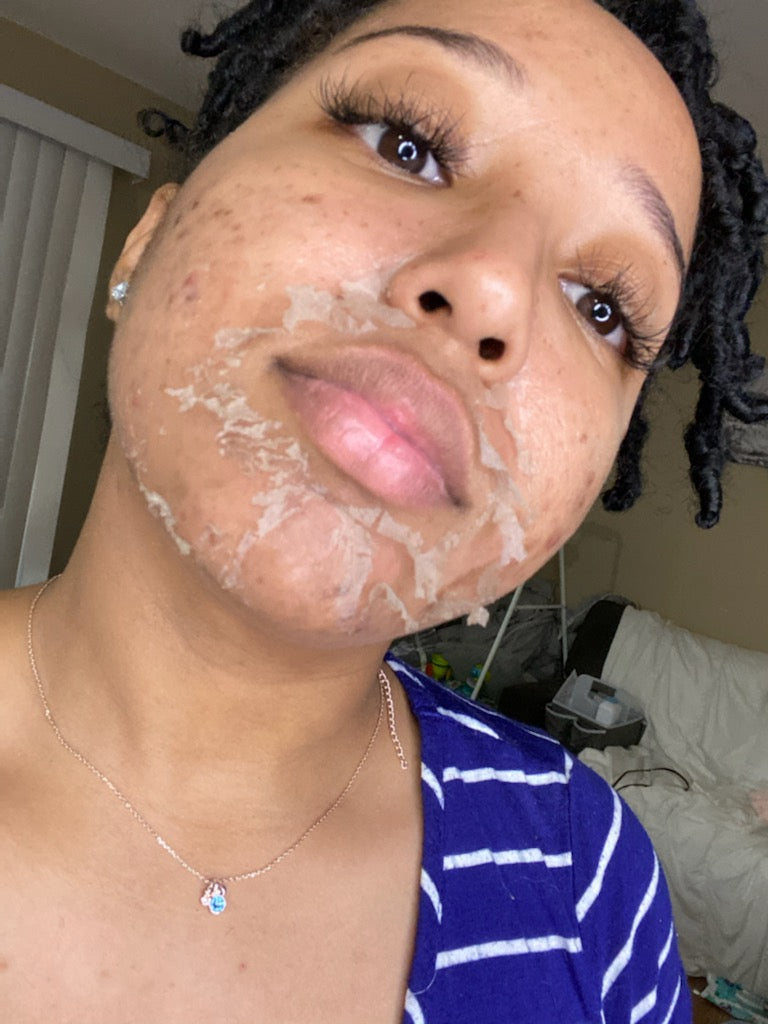 Chemical Peel Season