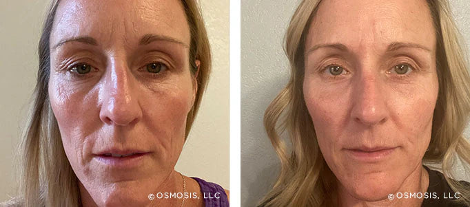 Recovery: Facial Fat Pad Therapy and Probiotic