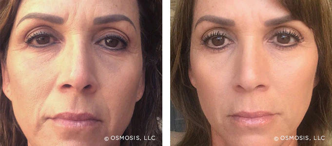 Recovery: Facial Fat Pad Therapy and Probiotic