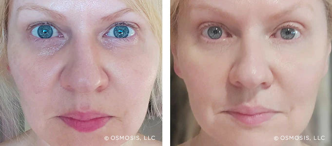 Recovery: Facial Fat Pad Therapy and Probiotic