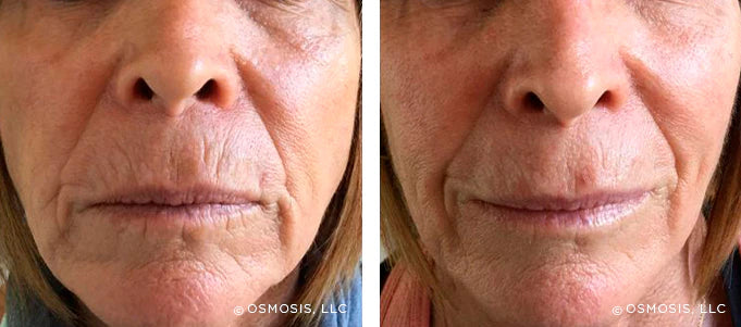Recovery: Facial Fat Pad Therapy and Probiotic